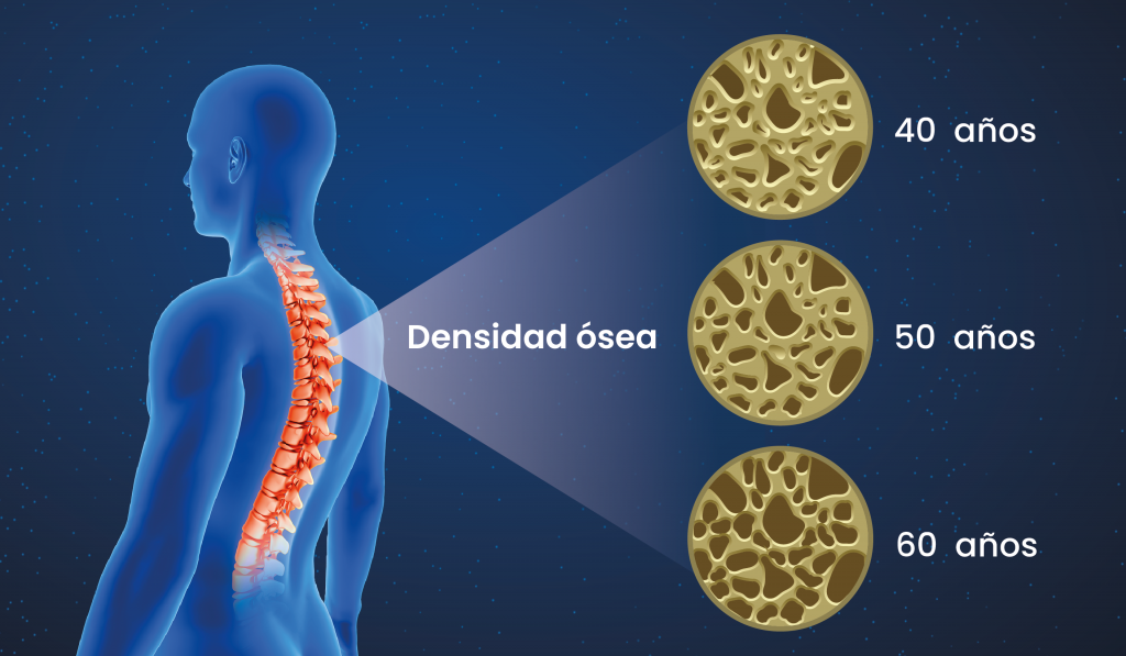 Edad y fragilidad ósea.